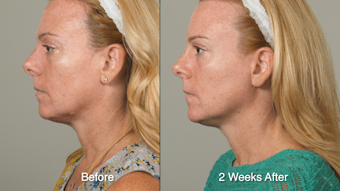 WRINKLE TREATMENT B&A - Patient 3