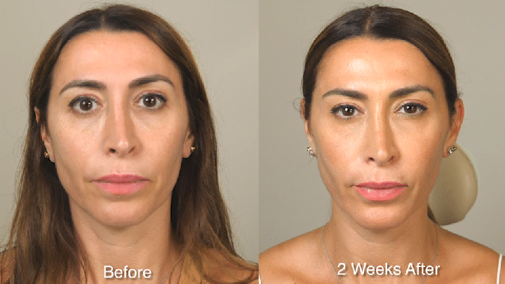 WRINKLE TREATMENT B&A - Patient 2