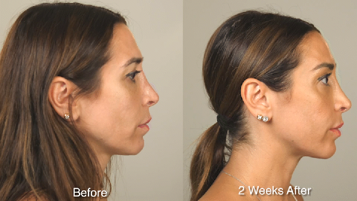 WRINKLE TREATMENT B&A - Patient 2