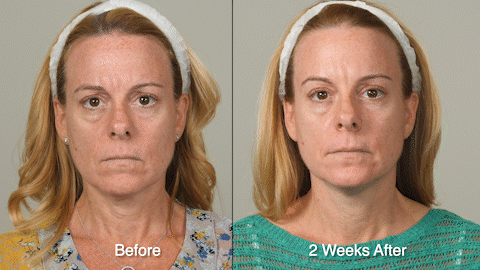 WRINKLE TREATMENT B&A - Patient 3
