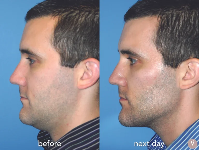 Y LIFT Patient Before & After Results Minimally Invasive Mini Facelift Procedure