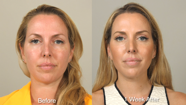 WRINKLE TREATMENT B&A - Patient 1