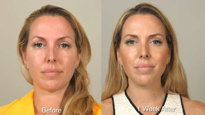 WRINKLE TREATMENT B&A - Patient 1