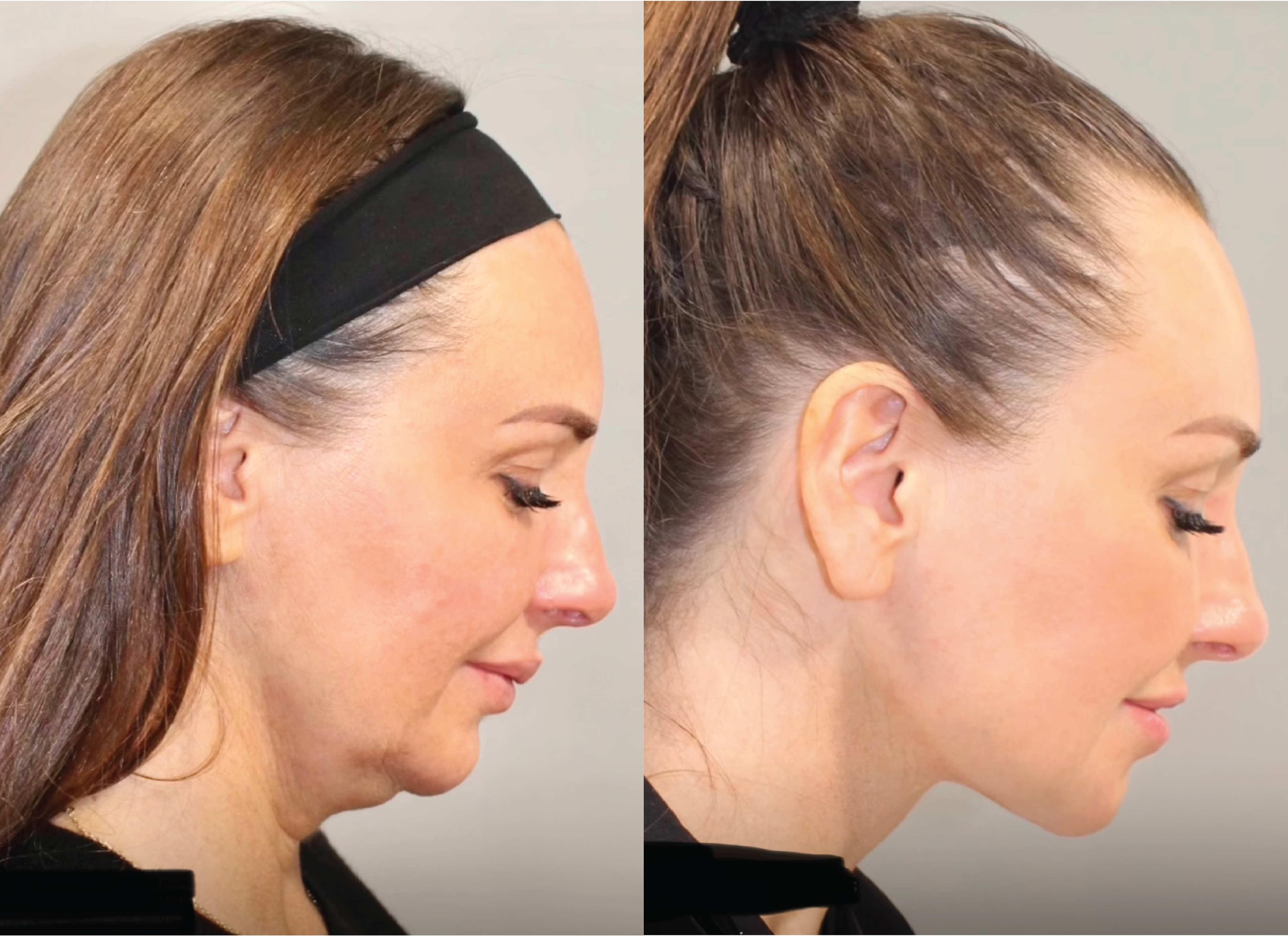 SurgYlift B&A - Patient 2