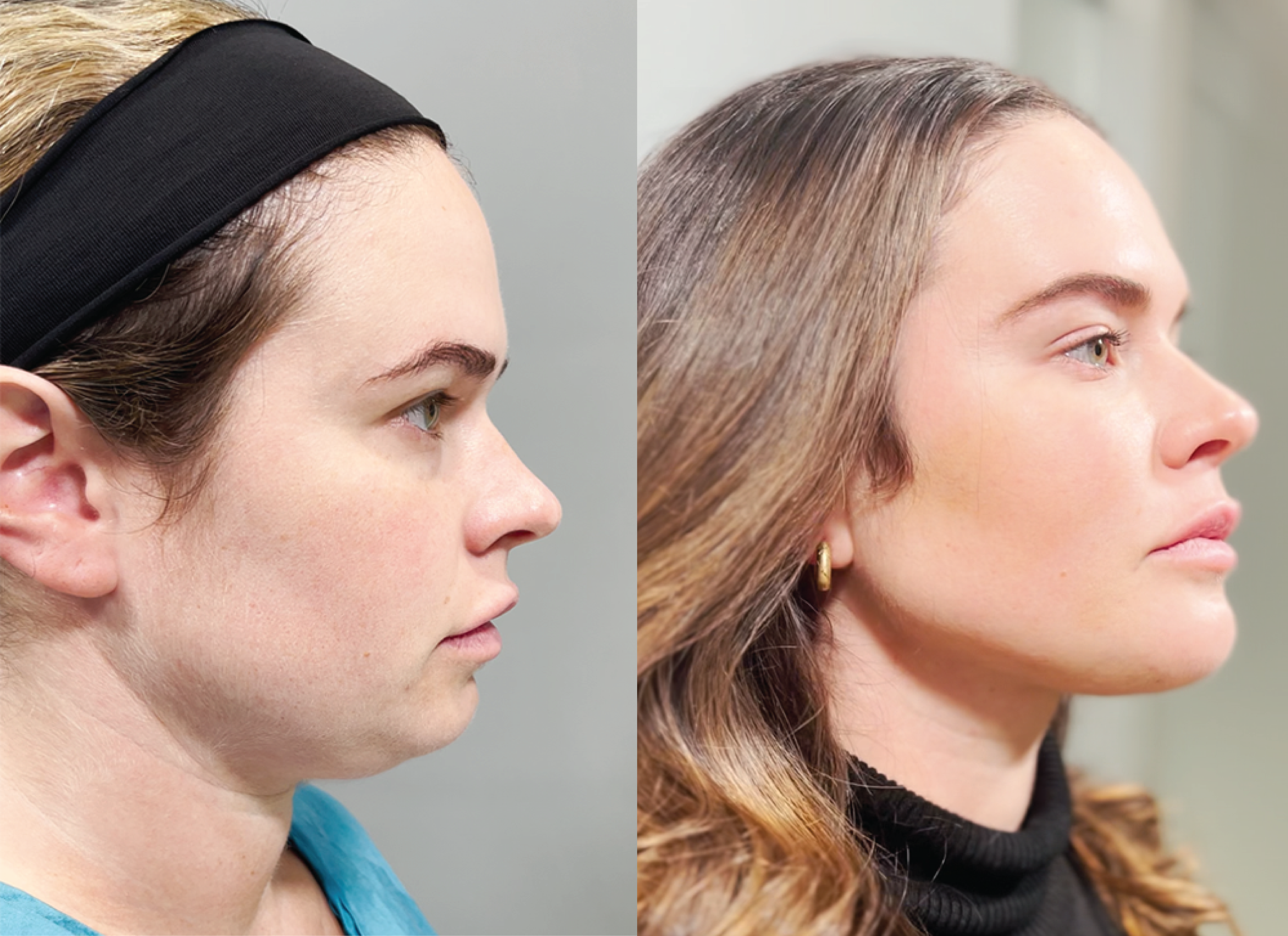 SurgYlift B&A - Patient 1